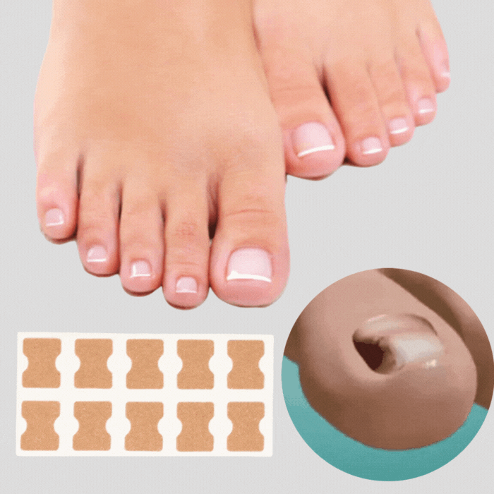 50% Rabatt || NagelWunder | Professionelle Korrekturpflaster für schöne, gesunde Nägel