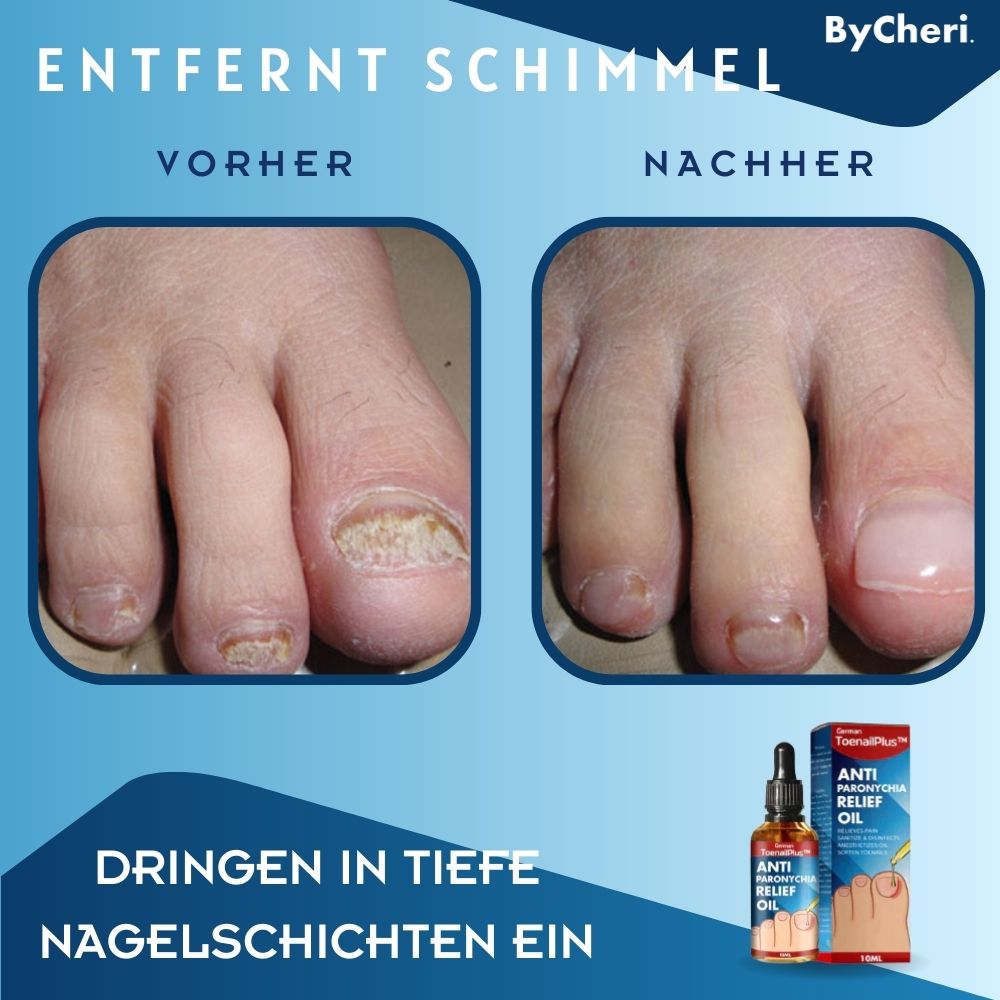 ToePerfect™ - Heilt Zehen- und Handnägel | 1+1 GRATIS TEMPORÄR