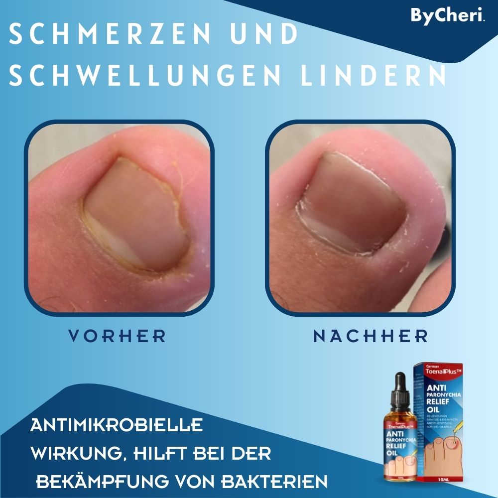 ToePerfect™ - Heilt Zehen- und Handnägel | 1+1 GRATIS TEMPORÄR