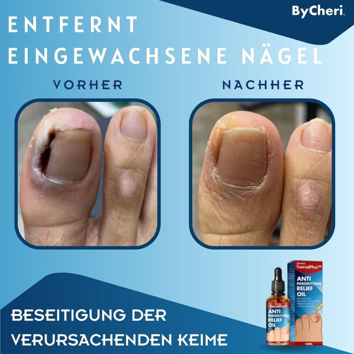 ToePerfect™ - Heilt Zehen- und Handnägel | 1+1 GRATIS TEMPORÄR