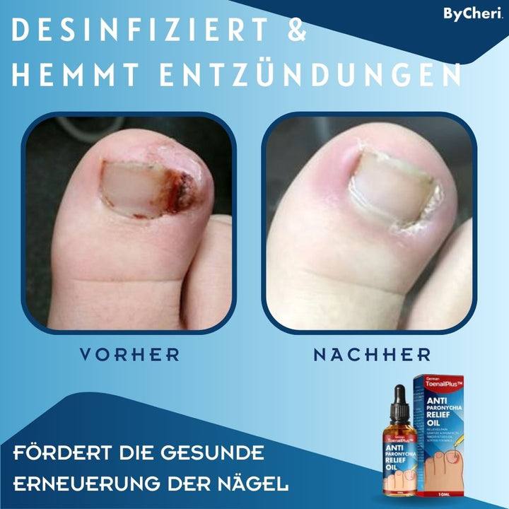 ToePerfect™ - Heilt Zehen- und Handnägel | 1+1 GRATIS TEMPORÄR