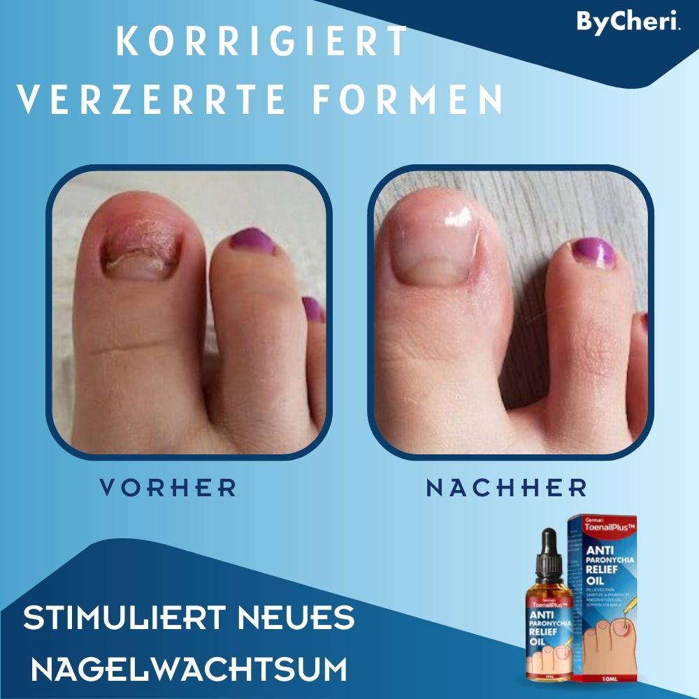 ToePerfect™ - Heilt Zehen- und Handnägel | 1+1 GRATIS TEMPORÄR