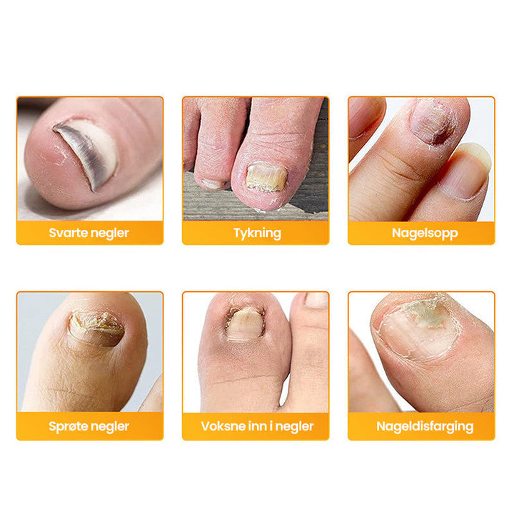 1+1 Gratis | Nailox  | Wirksame Behandlung von Nagelpilz
