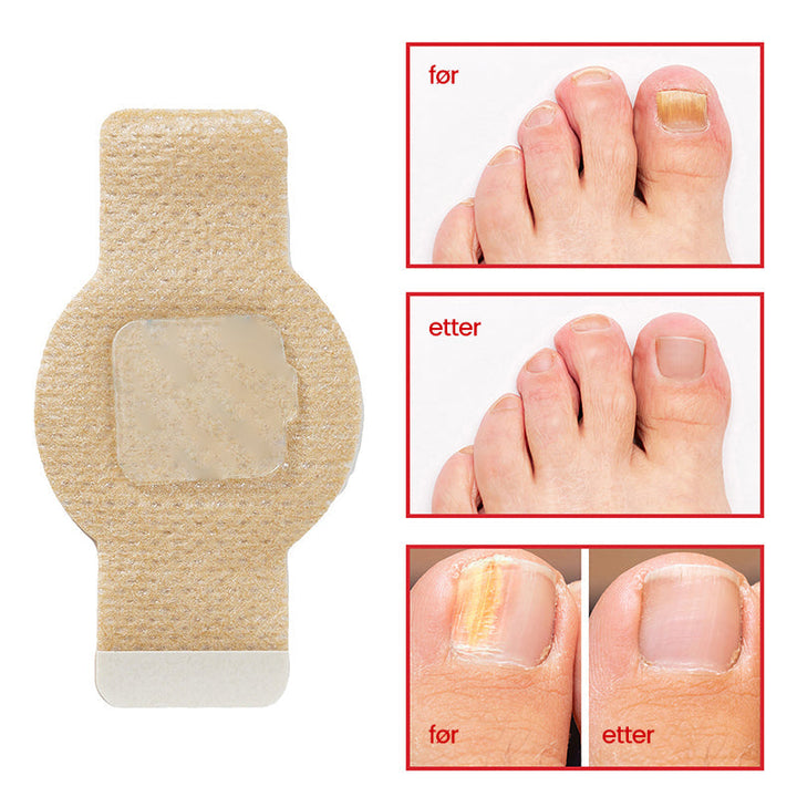1+1 Gratis | Nailox  | Wirksame Behandlung von Nagelpilz