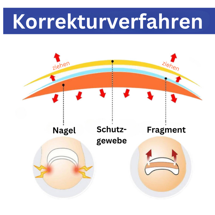 ToeCare™ - Ihre Lösung für eingewachsene Zehennägel!