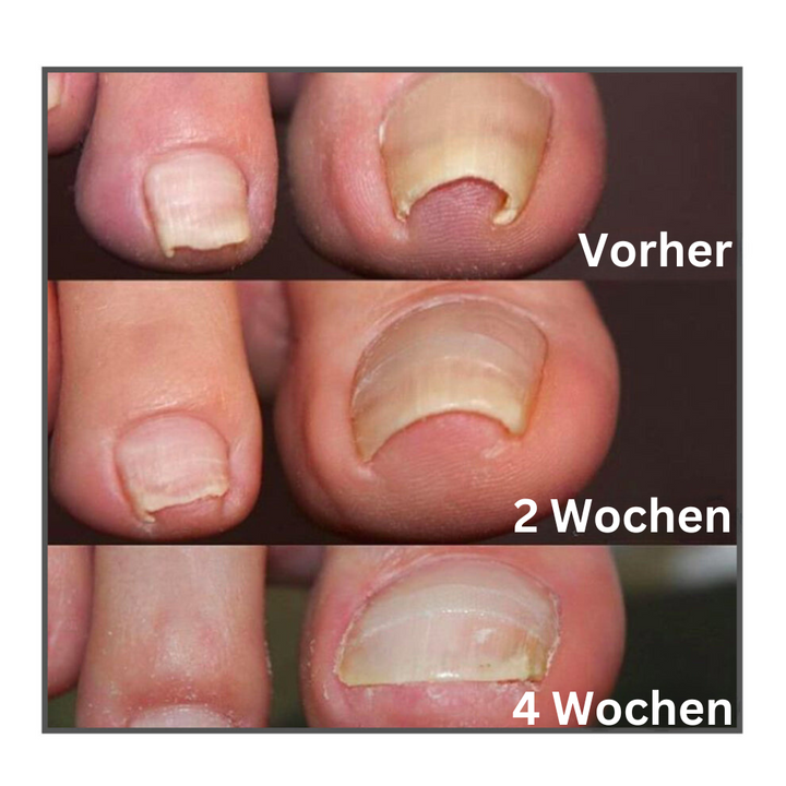 ToeCare™ - Ihre Lösung für eingewachsene Zehennägel!