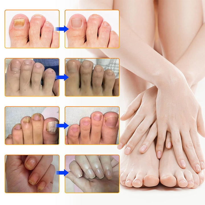 1+1 Gratis | Nailox  | Wirksame Behandlung von Nagelpilz
