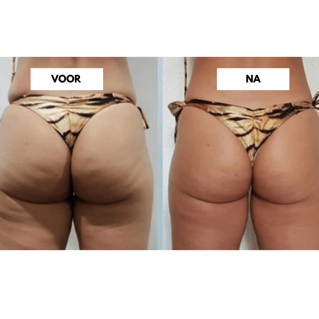 CelluCare Anti-Cellulite Gerät