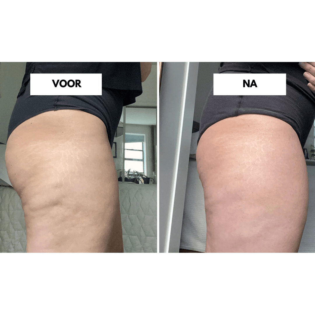 CelluCare Anti-Cellulite Gerät